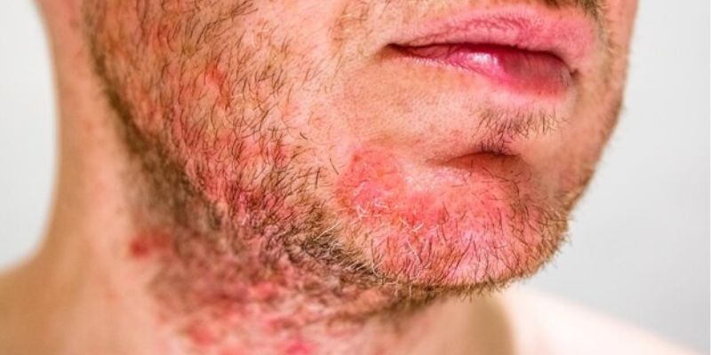 Tips Menangani Rosacea pada Pria/Freepik.com