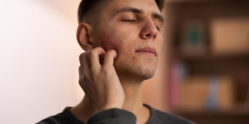 Tips Menangani Rosacea pada Pria/Freepik.com