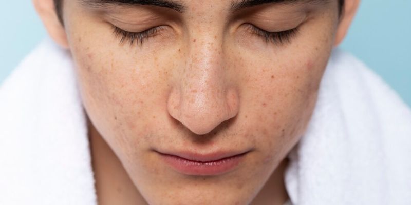 Hiperpigmentasi pada Pria/Freepik.com