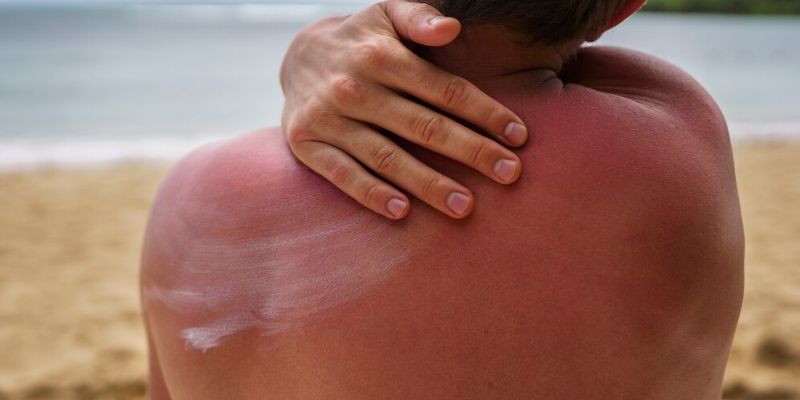 Apa Itu Sun Poisoning? Kenali Gejala, Penyebab, dan Cara Mengatasinya