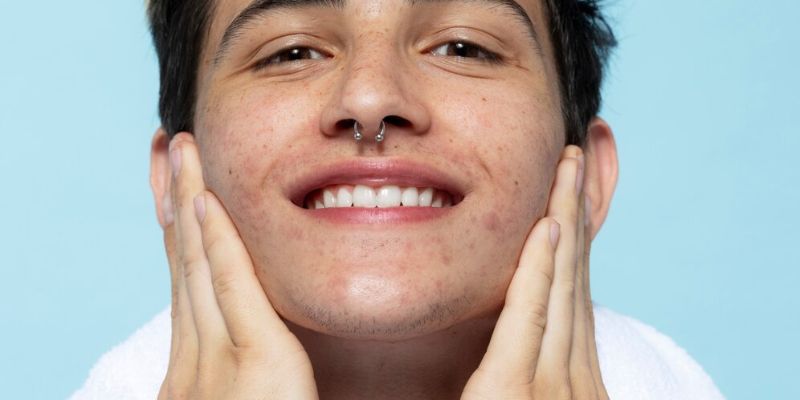 Tips Mengatasi Jerawat/Freepik.com