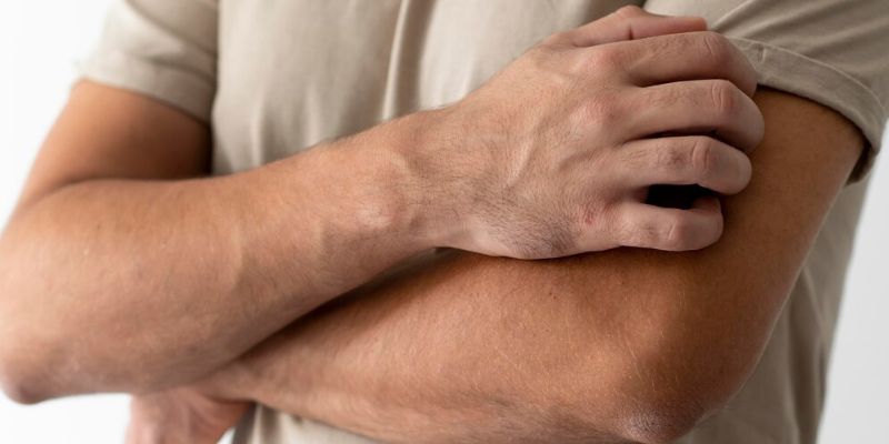Bikin Nggak Nyaman, Begini Cara Meredakan Gatal Parah Akibat Sunburn