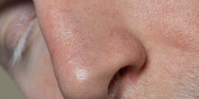 Sering Banget Diabaikan, Ini Fakta-Fakta tentang Blackhead yang Perlu Diketahui