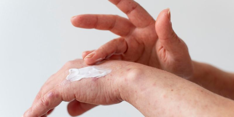 Cara Meredakan Gatal Akibat Sunburn/Freepik.com