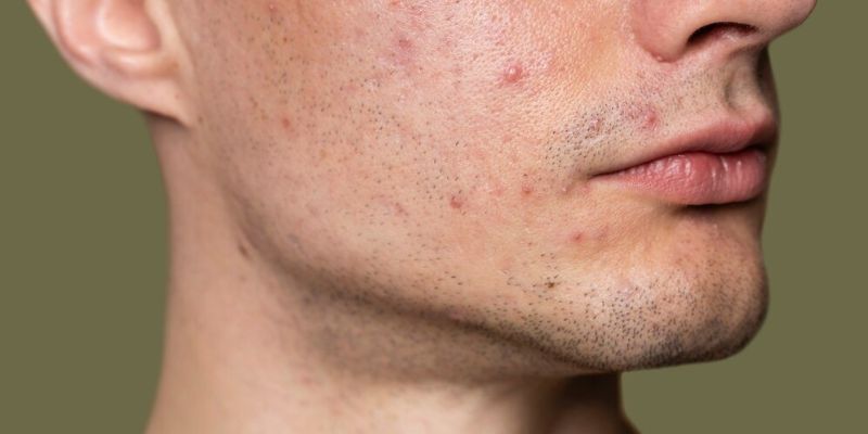 5 Jerawat yang Sering Menyerang Kulit Beserta Tips Penanganannya