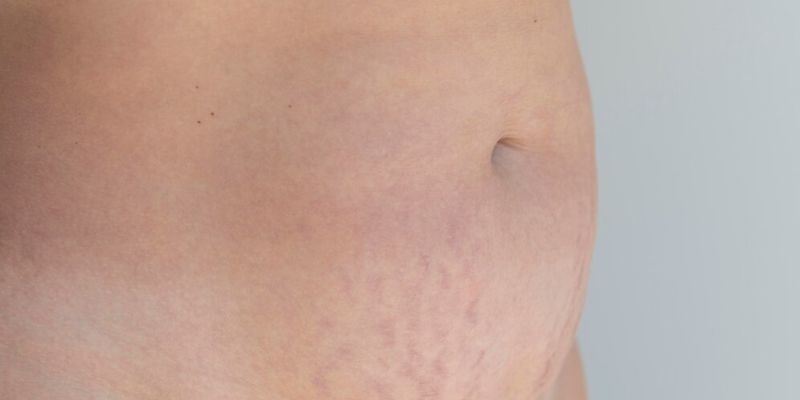 Stretchmarks pada Pria